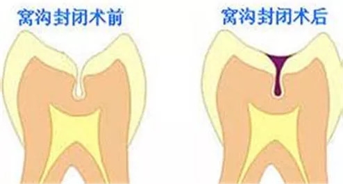 预防儿童龋齿涂氟还是窝沟封闭,有一点龋齿不想做窝沟封闭会怎样