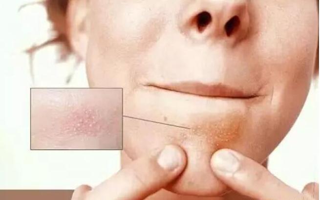 抿嘴出现的白色小颗粒,嘴下面起的密密麻麻大疙瘩是什么