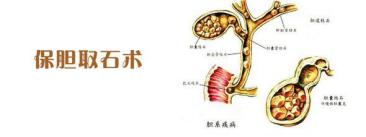 郑州哪个医院做保胆取石手术,济南哪个医院保胆取石好
