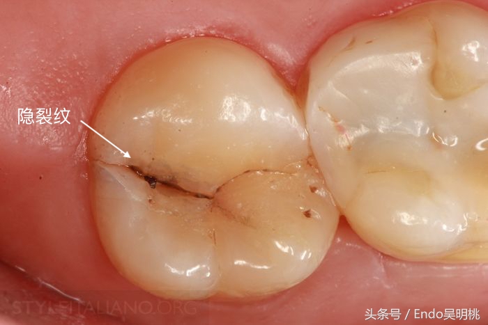 浅隐裂牙怎么处理,隐裂牙有自愈的可能