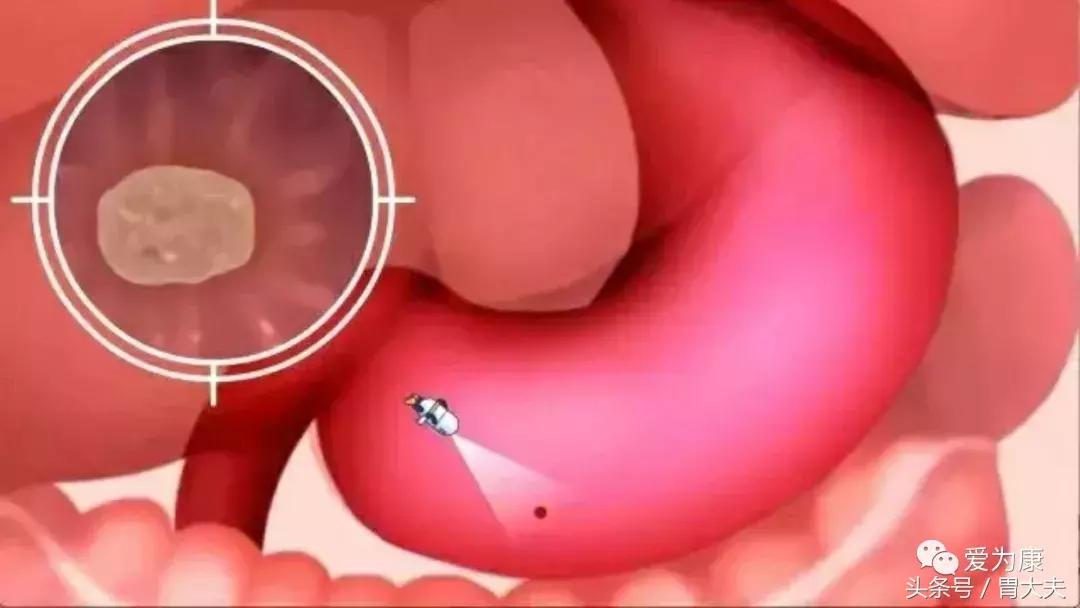 胶囊机器人胃镜可以检查哪些,黑科技胃镜胶囊和普通胃镜