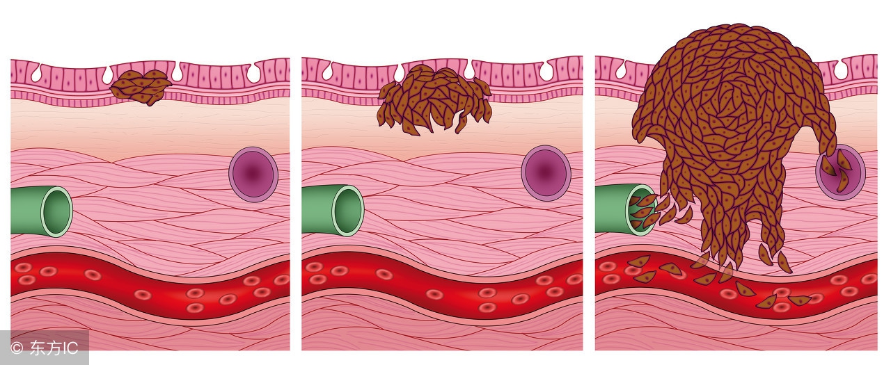 从小就有的痣可能会是黑色素瘤吗,先天性黑素细胞痣恶变的概率大吗