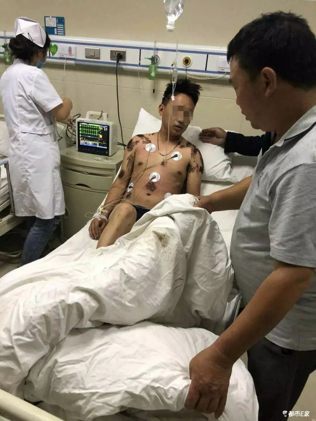 被马蜂蜇了的最快速处理办法,被马蜂蛰的100种方法