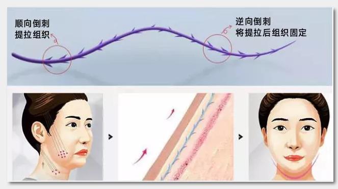 面部线雕失败全过程,面部线雕失败的图片