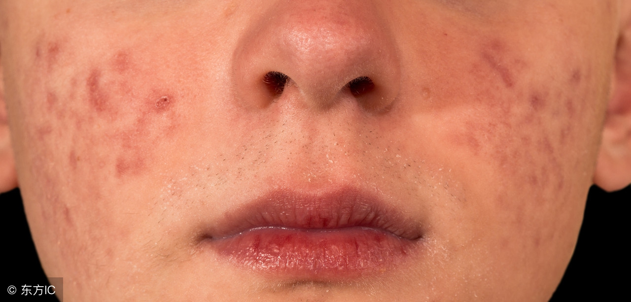 脸上螨虫怎么治才能彻底消灭,脸上螨虫怎么治可以除根
