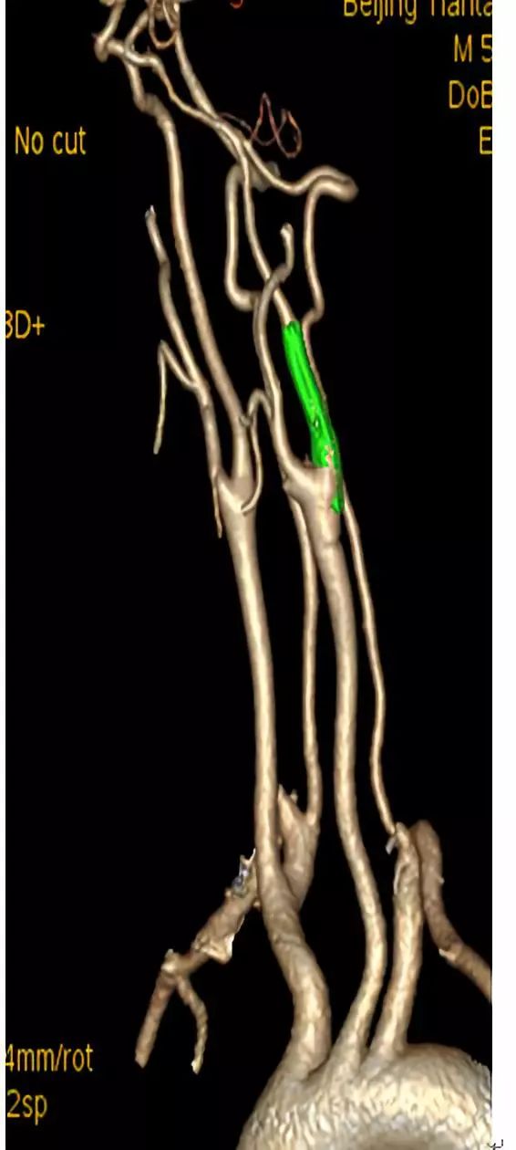 学术快报｜莫大鹏：颈动脉病变的复合手术治疗原则