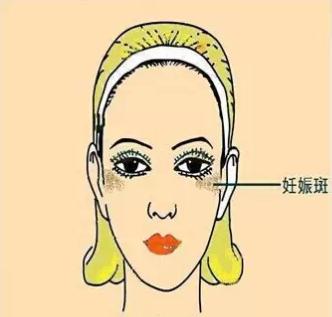 如何识别各种不同的斑,不同位置的色斑叫什么