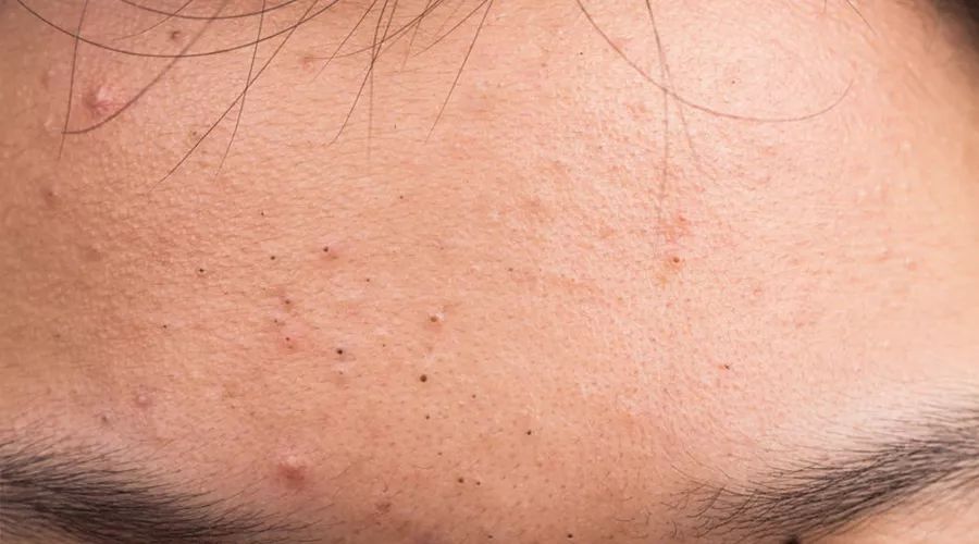 痘痘一直不好为哪般,痘痘一直不好应该怎么护肤