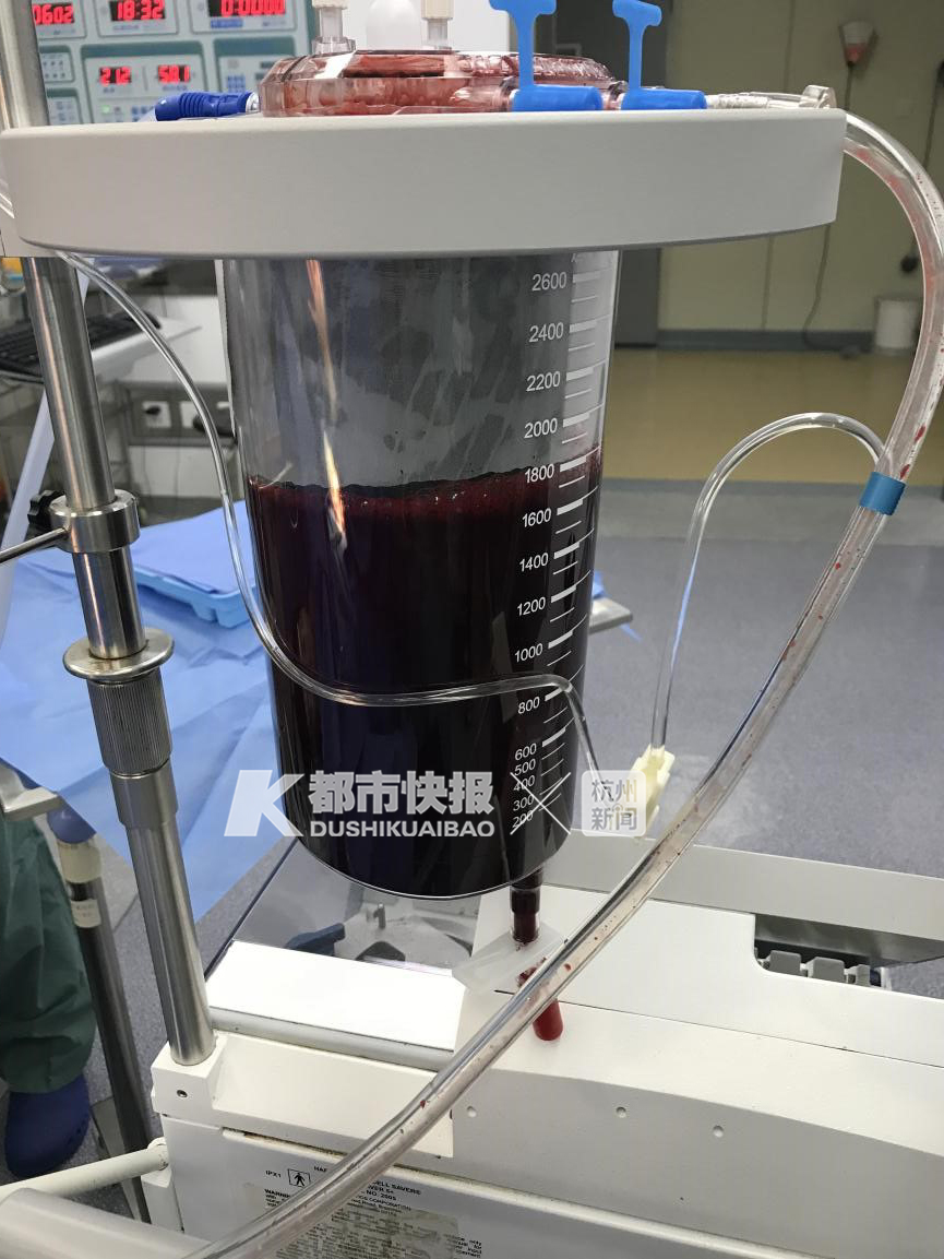 一个小女孩大出血,女孩腹腔出血2000毫升