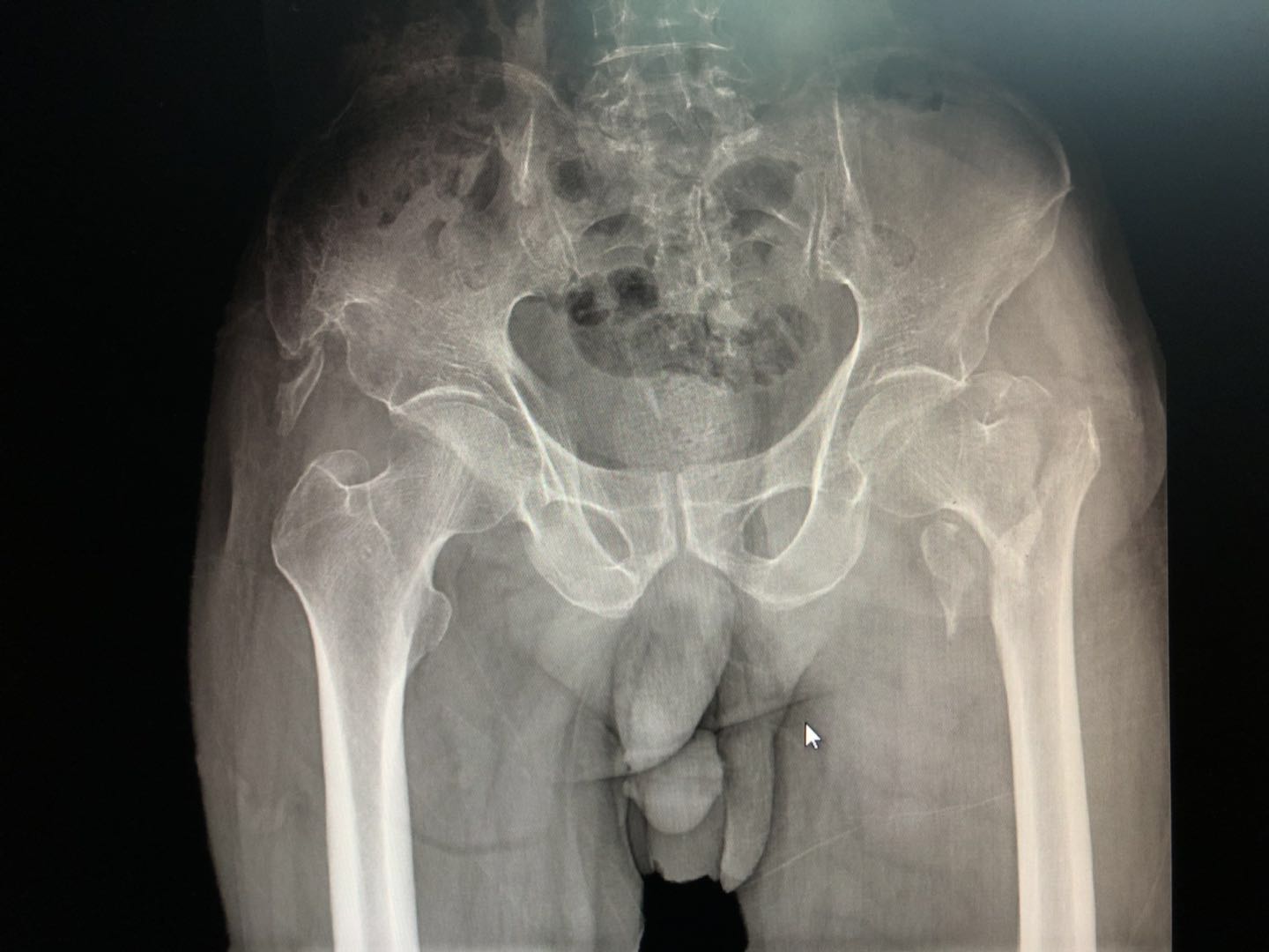 什么病做手术存活下来的几率低,什么病需要过一段时间才做手术