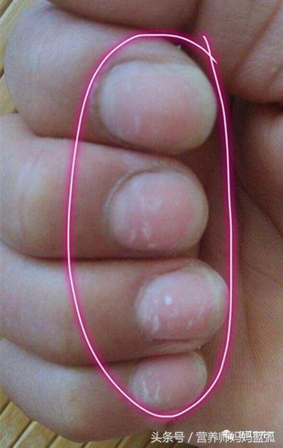 宝宝指甲白斑、凹陷、薄脆、倒刺、分层……原来是这么回事！