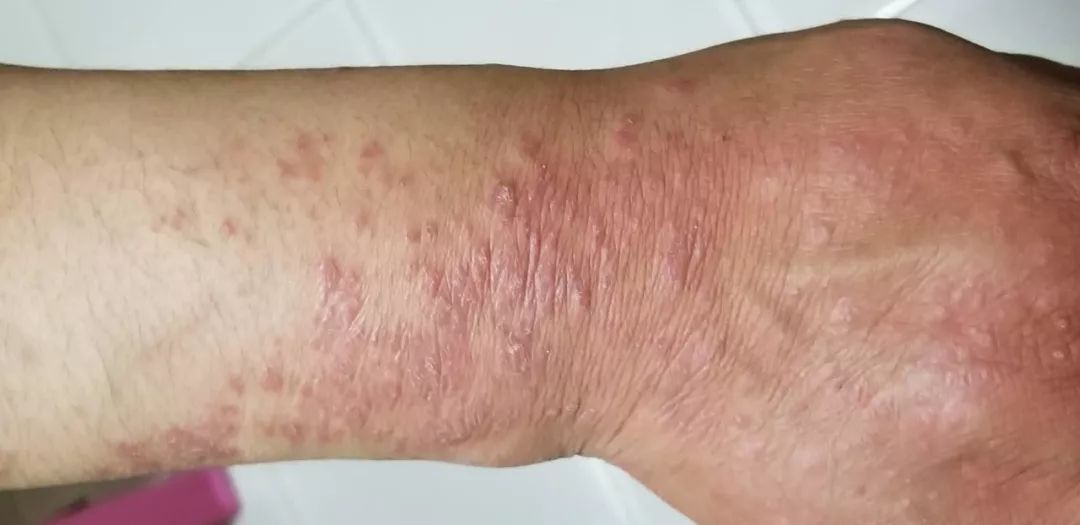 娴欐睙鐪佷腑鍖绘不鐤楅摱灞戠梾,鍏勫紵淇╅兘寰楃櫧鐧滈