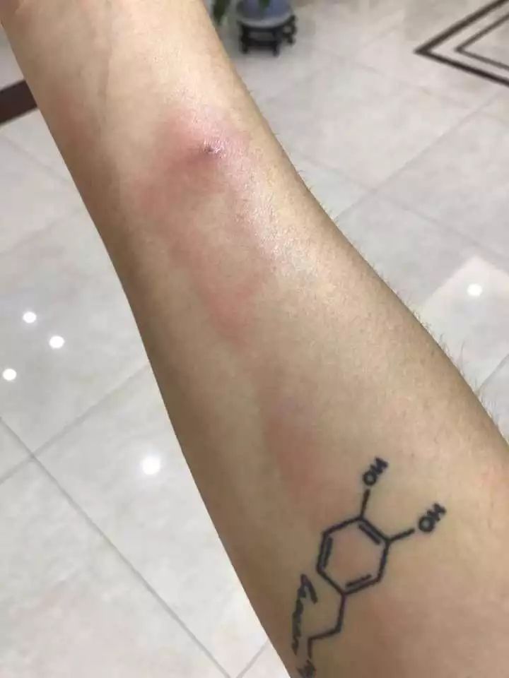 小伙被蚂蚁咬了一口,小伙被虫咬住了一下