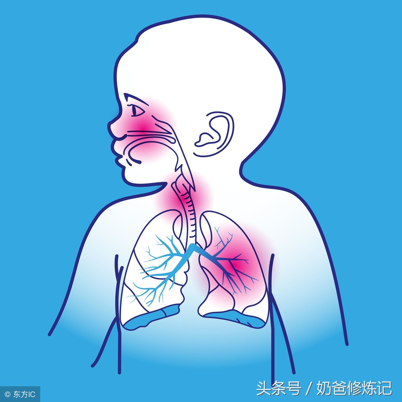 新生儿肺透明膜病的主要病因,认知婴幼儿