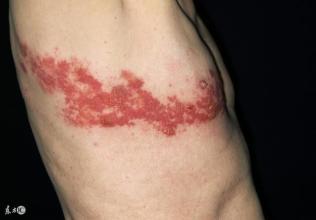 痘痘可以等它自然消失吗,痘痘消不掉有颗粒感