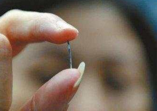 女生产后上环,女子取环6年后去医院取