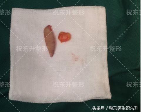 做眼袋提眉手术能变得年轻吗,哪种人不适合做提眉去眼袋