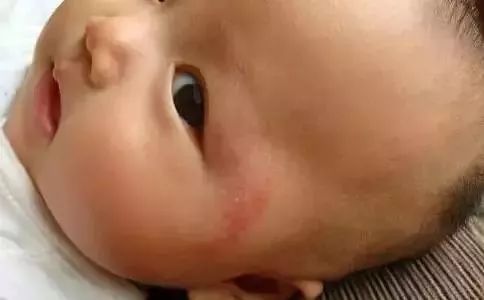 秋季孩子身上痒是什么原因,夏天宝宝身上总是痒怎么回事
