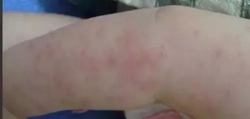 宝宝皮肤痒有什么方法止痒,宝宝冬天皮肤痒教你一招