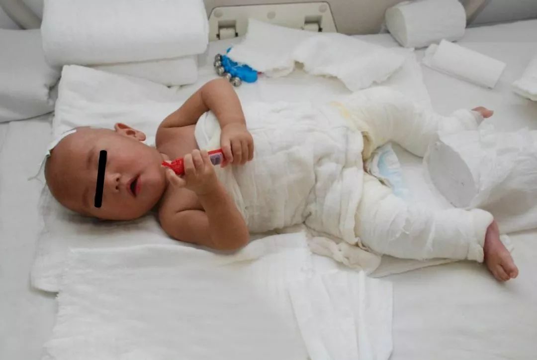 宝宝被开水烫伤妈妈去救他,婴儿被100开水烫伤后续