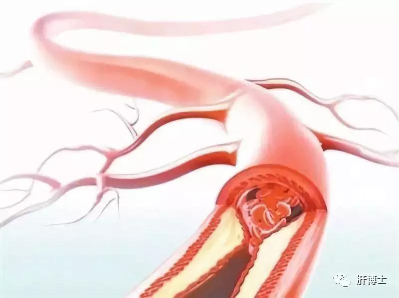 肝硬化引起食管静脉曲张轻度,肝硬化食道静脉曲张的治疗方案