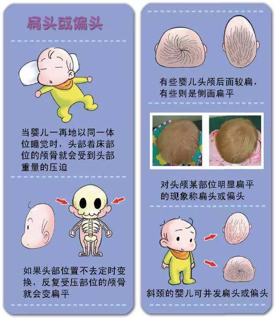 小儿斜颈的原因及治疗方法,小儿斜颈手术治疗时机