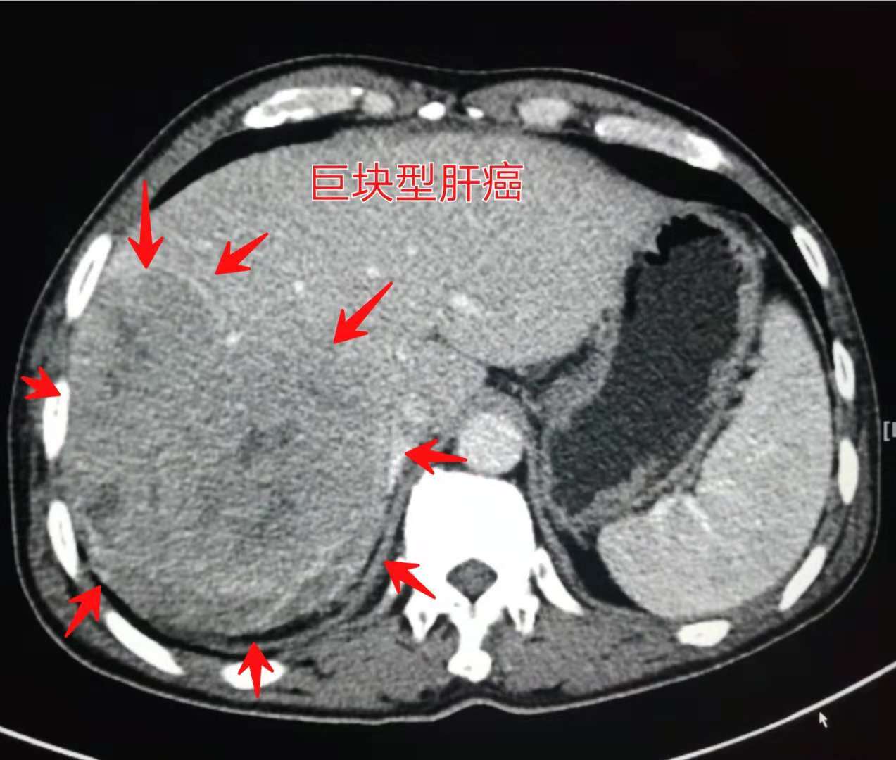 咳嗽几个月都没好会得肺癌吗,29岁女孩咳嗽一周肺癌