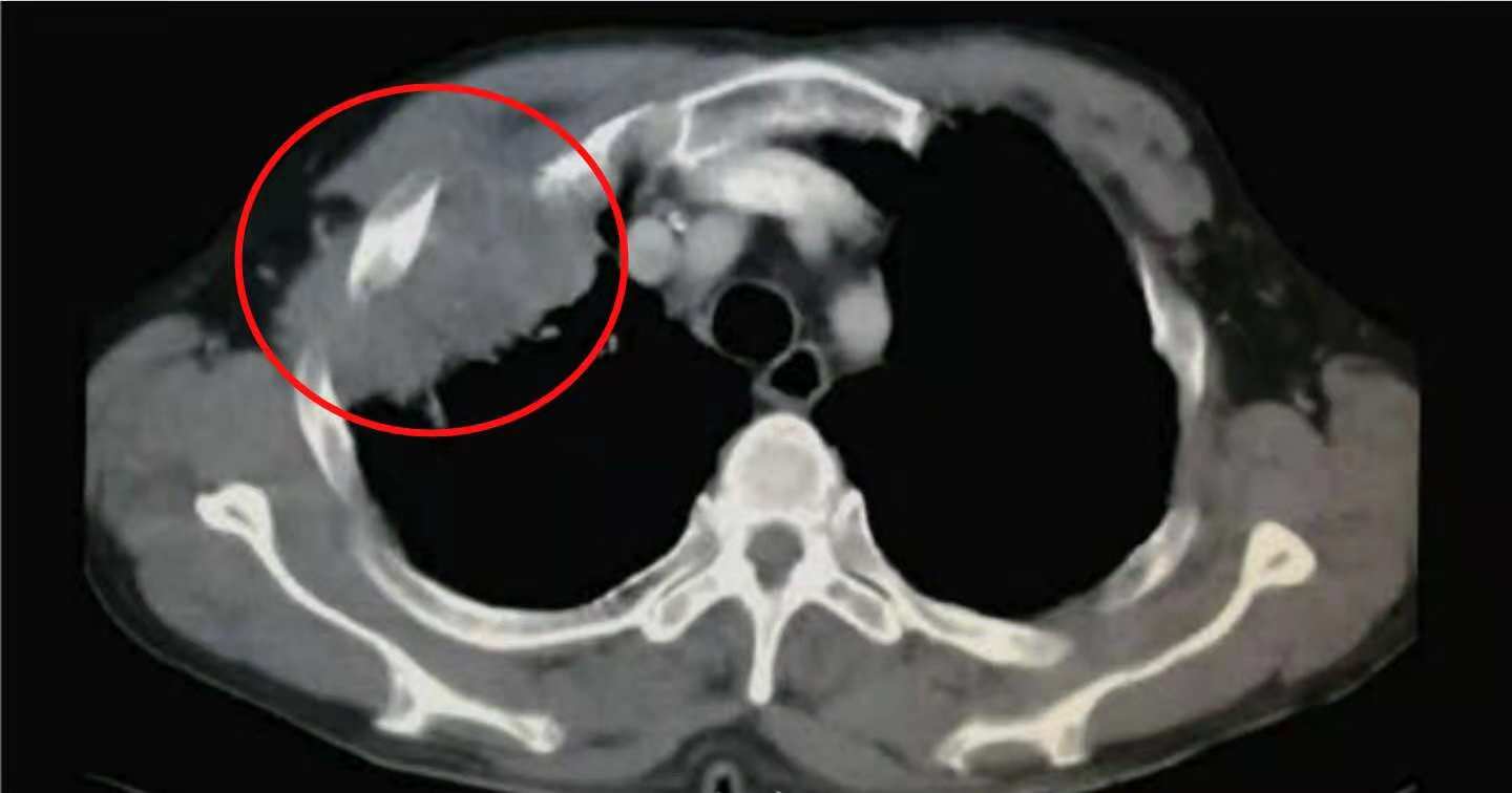 咳嗽几个月都没好会得肺癌吗,29岁女孩咳嗽一周肺癌