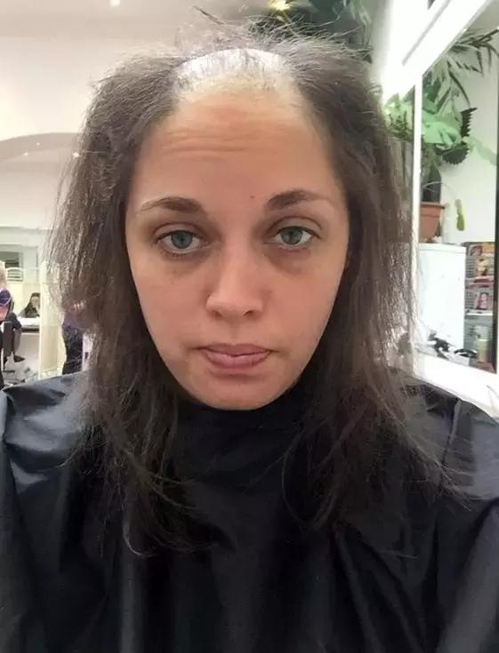 儿时有拔毛癖,青少年拔毛癖怎么彻底解决