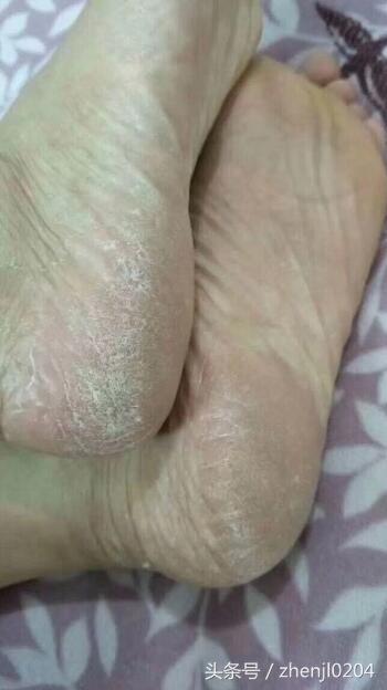 晚间脚气知识科普,科普脚气小知识