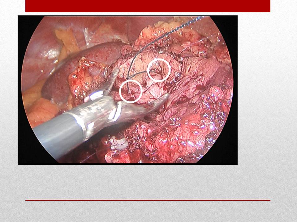 泌尿外科腹腔镜手术适应症,泌尿外科腹腔镜并发症