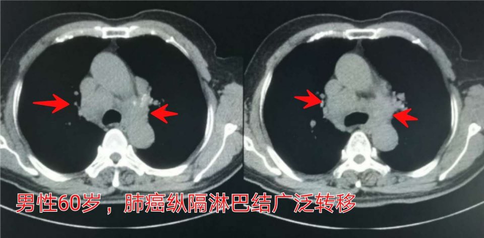 癌症晚期带病长期生存,癌症患者的生存记录