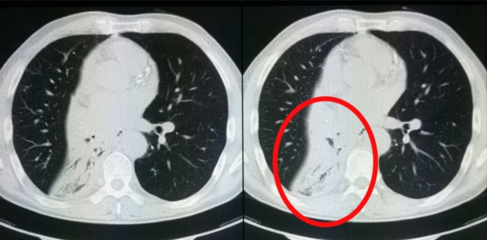 癌症晚期带病长期生存,癌症患者的生存记录