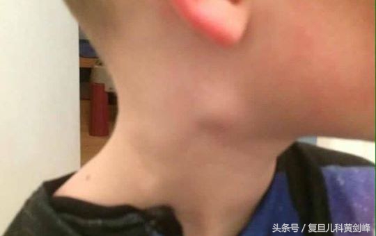 小孩脖子上摸到小疙瘩怎么回事,宝宝脖子上摸起来有疙瘩怎么回事