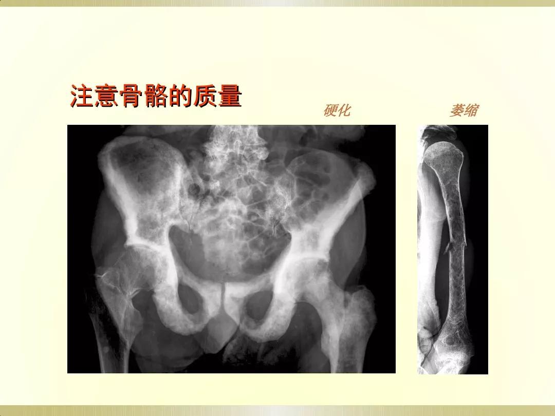 骨科x光片读片技巧,放射科骨科读片教程