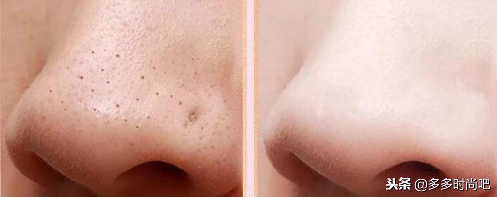 芦荟胶改善黑头怎么用,芦荟胶怎么去黑头效果好