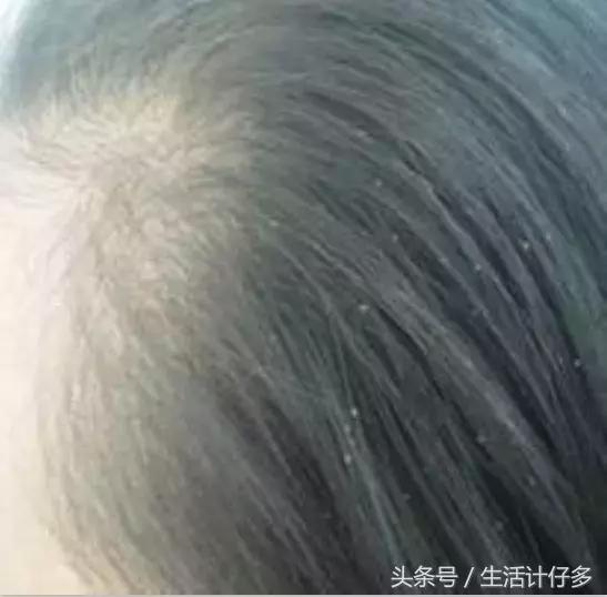 为什么全家人都有头皮屑,18岁女孩头皮屑多为什么