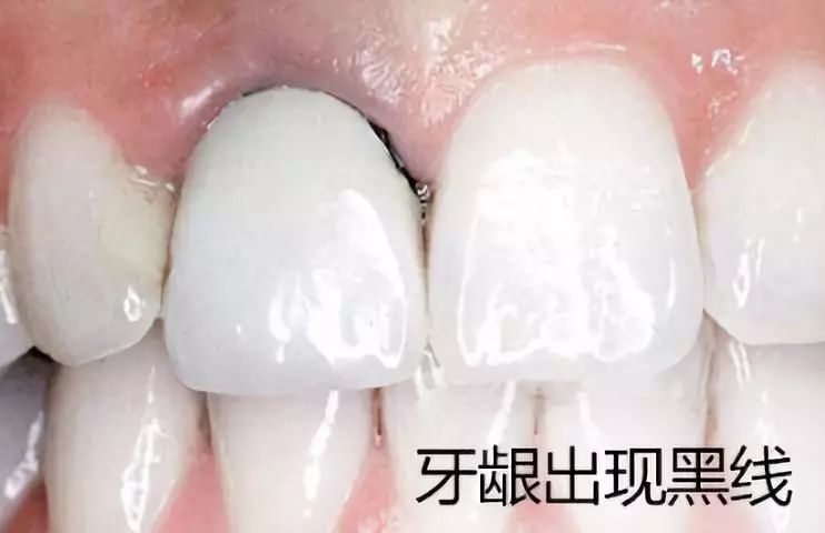 烤瓷牙与全瓷牙价格对比,烤瓷牙和全瓷牙价格差多少钱一颗