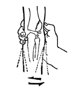 中医骨折治疗原则,中医骨伤整复术