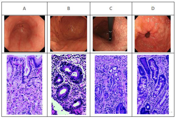 检查出非萎缩性胃炎,病理诊断慢性非萎缩性胃炎轻度