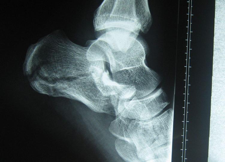 脚后跟疼长了骨刺怎么办,脚后跟痛还有骨刺怎么办啊