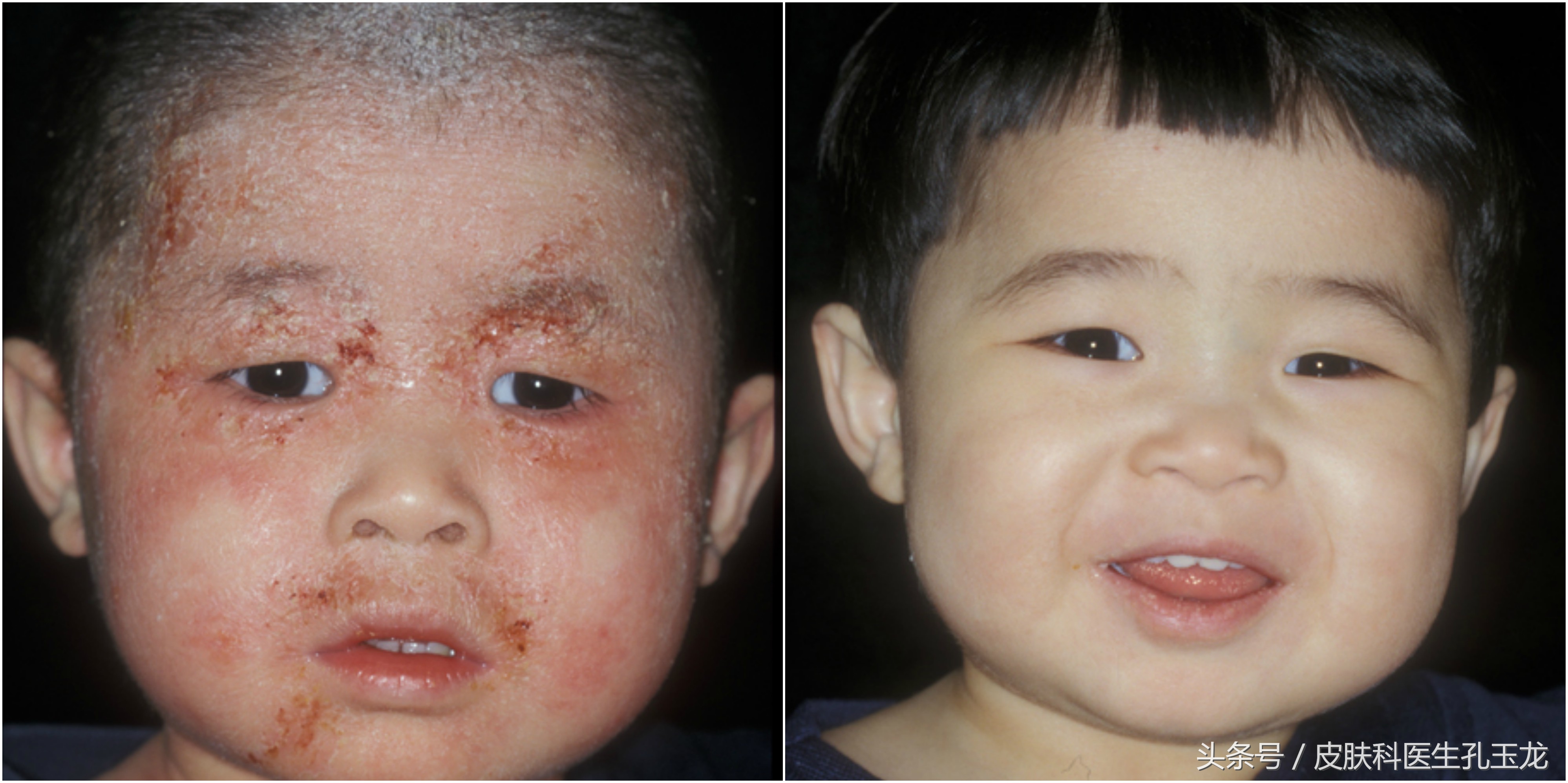 婴儿湿疹导致皮肤干燥怎么治疗,宝宝湿疹皮炎是什么原因引起的