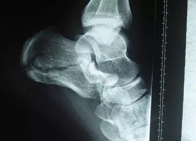 脚后跟疼是肾有问题么,专治脚后跟疼的骨刺特效药