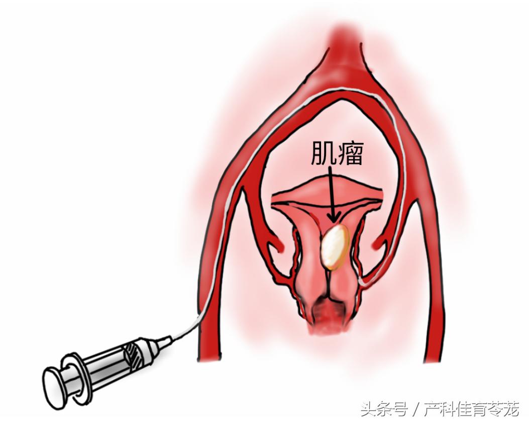 子宫肌瘤切除后复发该怎么办,子宫前壁肌瘤不切子宫会复发吗