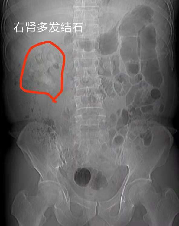 有冶肾结石肾囊肿的好医生吗,肾结石外科手术治疗最新方案