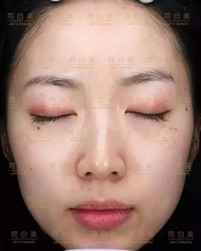 祛斑变美的过程,简美人祛斑祛黄褐斑