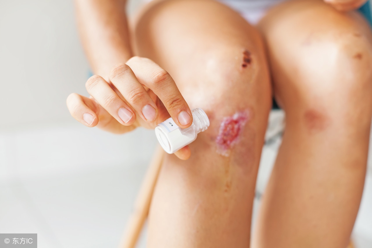 剖腹产刀疤可以一直用碘伏消毒吗,剖腹产伤口多久后可以用碘伏消毒