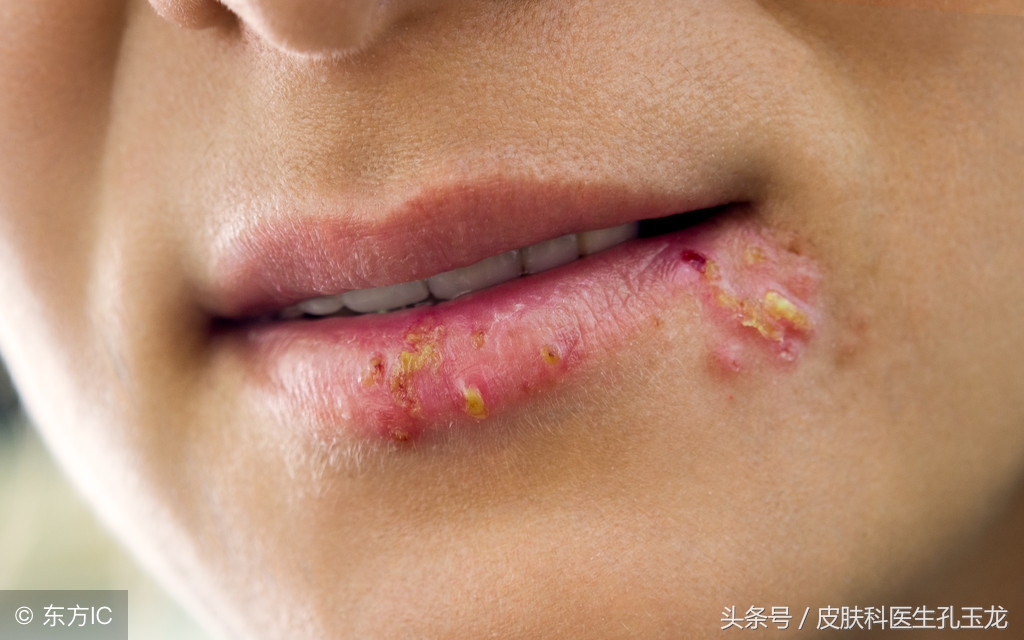 皮肤科单纯疱疹专家,上火嘴上起的疱疹什么原因