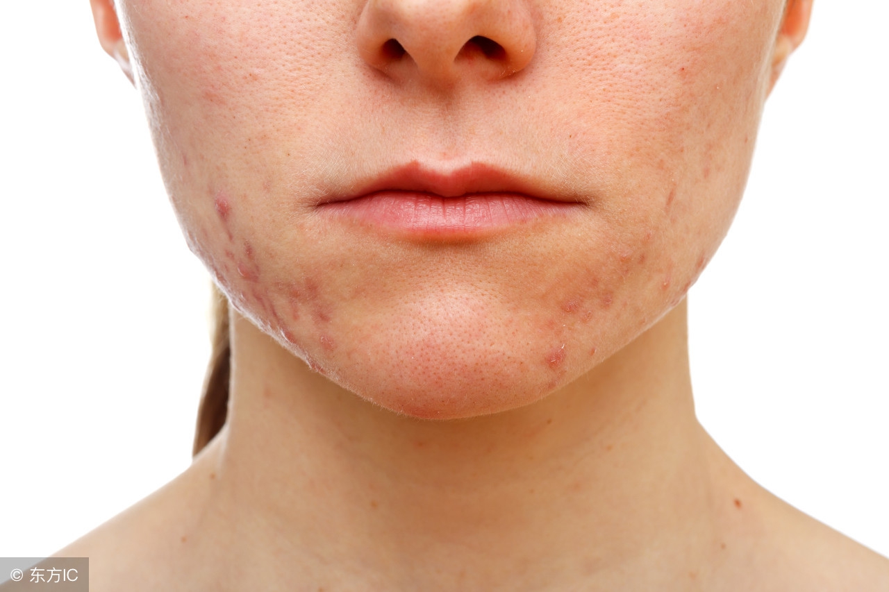 下巴长粉刺身体哪里出问题了,下巴过敏性粉刺是哪里出了问题