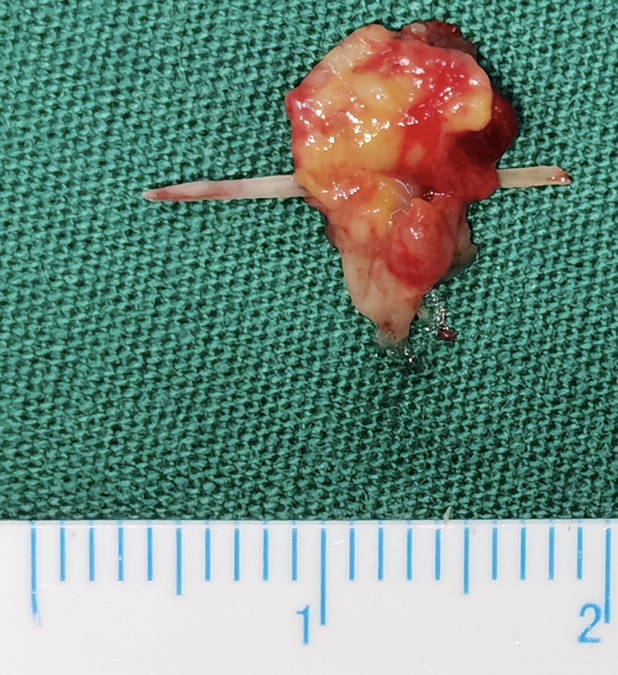 鱼刺在舌头上容易成舌癌吗,鱼刺扎进喉咙肉里10多年